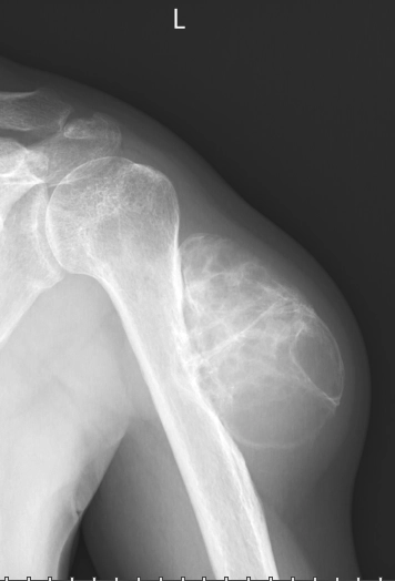 Röntgenfelvétel Váczy József felkarcsontrákjáról, amely a Lélekélettan hitelességét és a fizikai gyógyulás valóságát igazolja a Biologika-Újmedicina szemlélet tükrében.